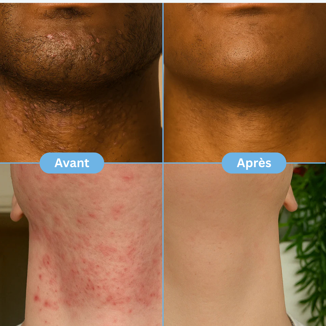 SmoothFix™ – Soin Anti-Poils Incarnés
