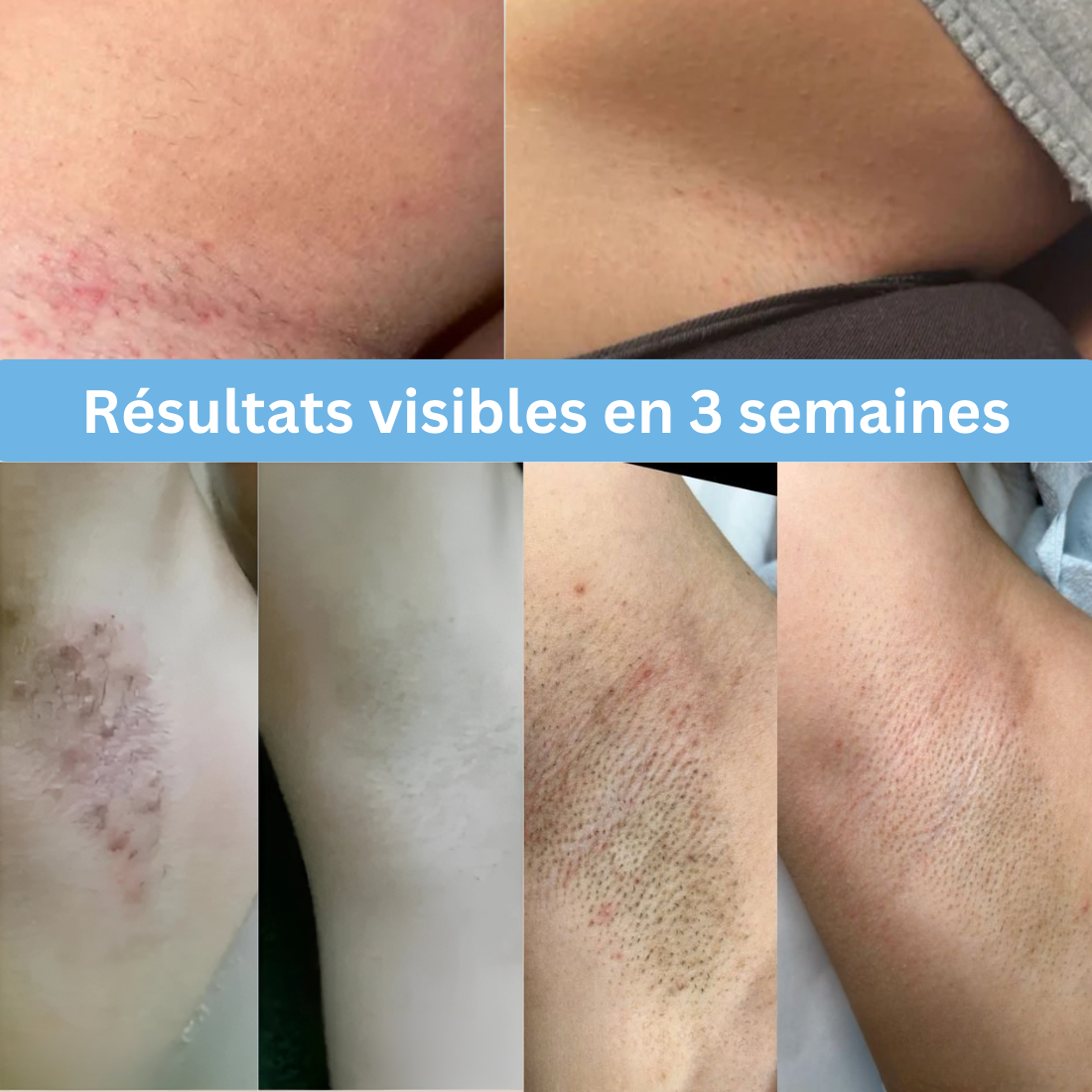 SmoothFix™ – Soin Anti-Poils Incarnés